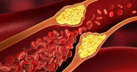 Какие признаки говорят о повышенном холестерине терапевт