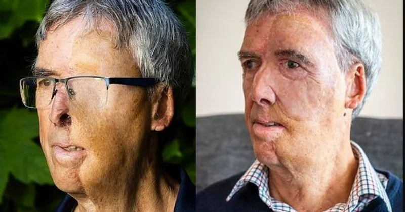 Потерявшему половину лица в ДТП мужчине напечатали протез на 3D принтере